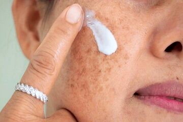 اگر پوست خشکی دارید علت آن کمبود این ویتامین‌ها است